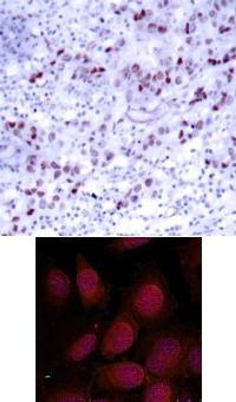 <b>Top Image:</b> Immunohistochemical analysis of paraffin-embedded human breast carcinoma tissue using GATA1 (Ab-142) .<b>Bottom Image:</b> Immunofluorescence staining of methanol-fixed HeLa cells using GATA1 (Ab-142) .