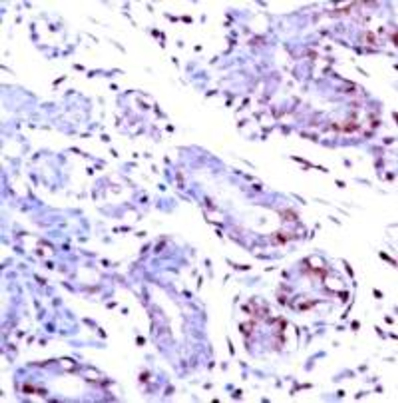 Immunohistochemical analysis of paraffin-embedded human breast carcinoma tissue using STAT1 (Ab-701) .