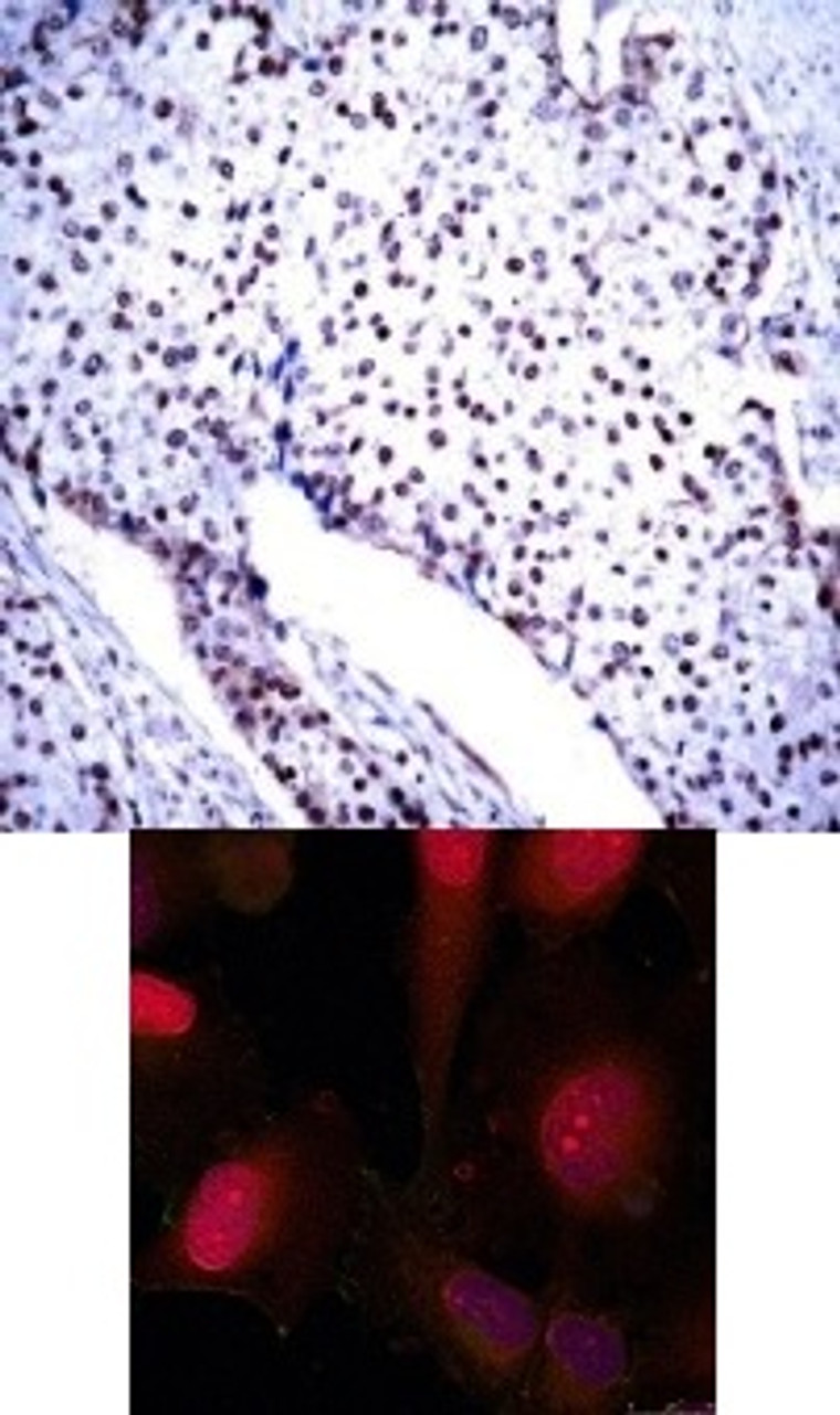 <b>Top Image:</b> Immunohistochemical analysis of paraffin-embedded human breast carcinoma tissue using STAT3 (Ab-705) .<b>Bottom Image:</b> Immunofluorescence staining of methanol-fixed HeLa cells using STAT3 (Ab-705) antibody (#21045, Red) .