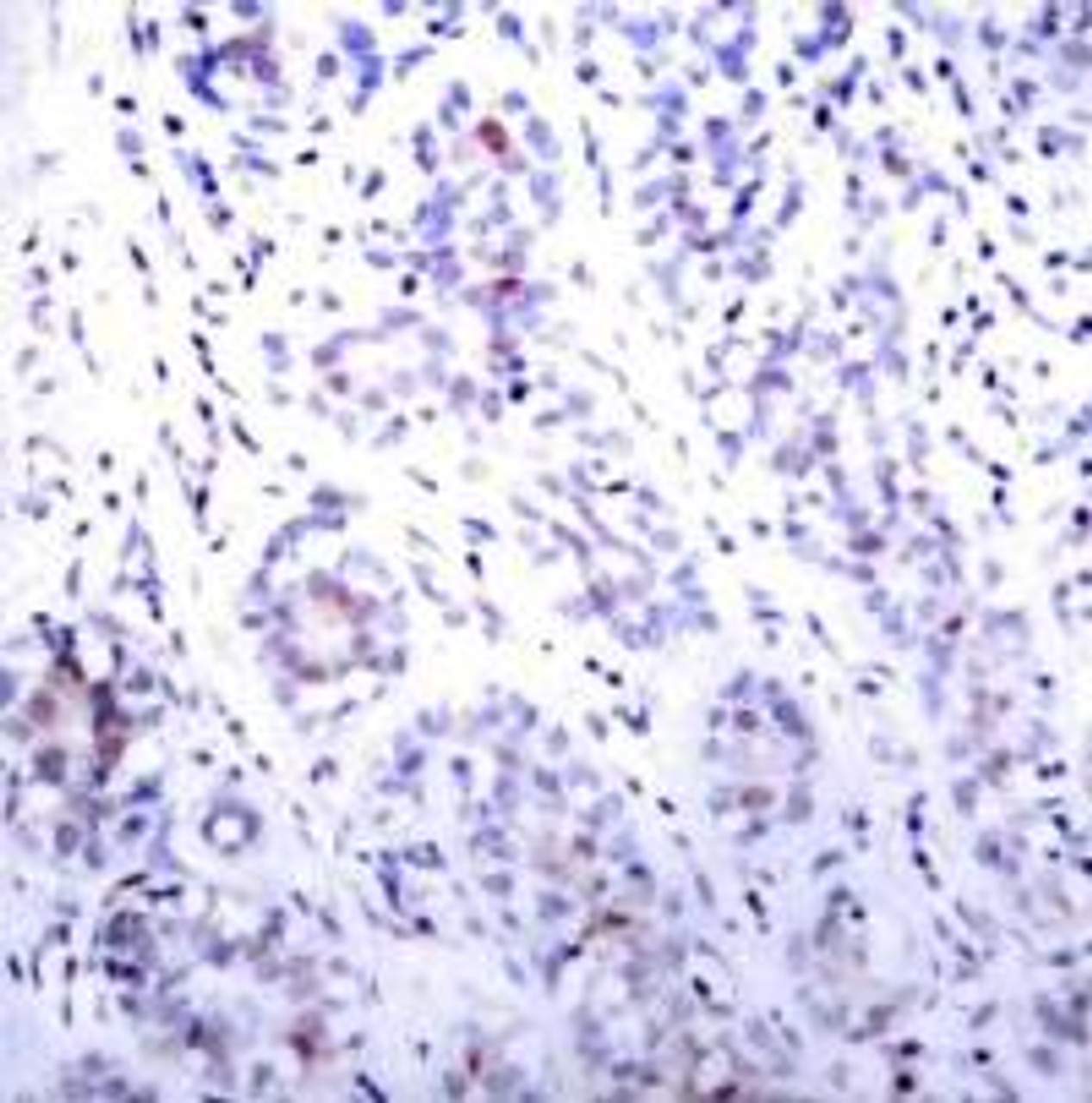 Immunohistochemical analysis of paraffin-embedded human breast carcinoma tissue using STAT3 (Ab-727) .