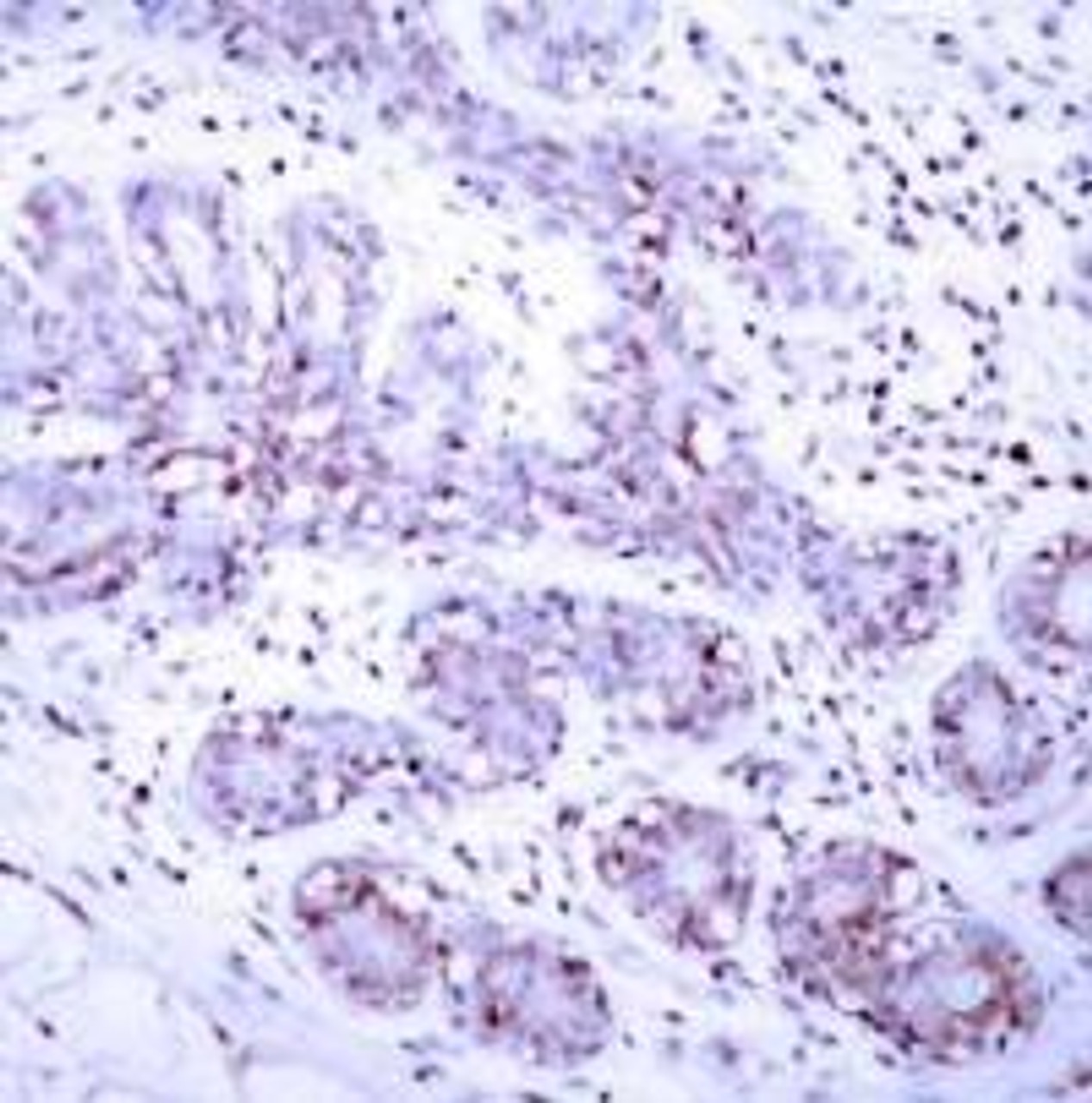 Immunohistochemical analysis of paraffin-embedded human breast carcinoma tissue using STAT4 (Ab-693) .
