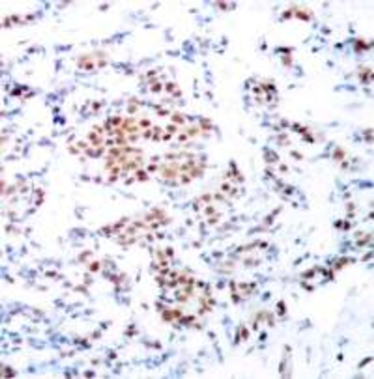 Immunohistochemical analysis of paraffin-embedded human breast carcinoma tissue using STAT5A (Ab-694) .