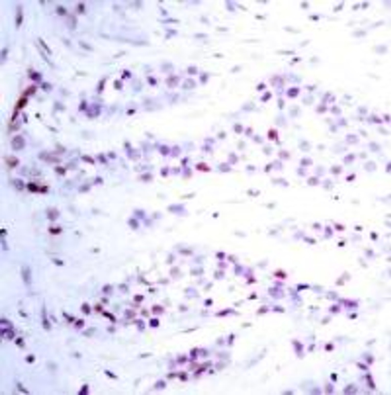Immunohistochemical analysis of paraffin-embedded human breast carcinoma tissue using STAT6 (Ab-641) .