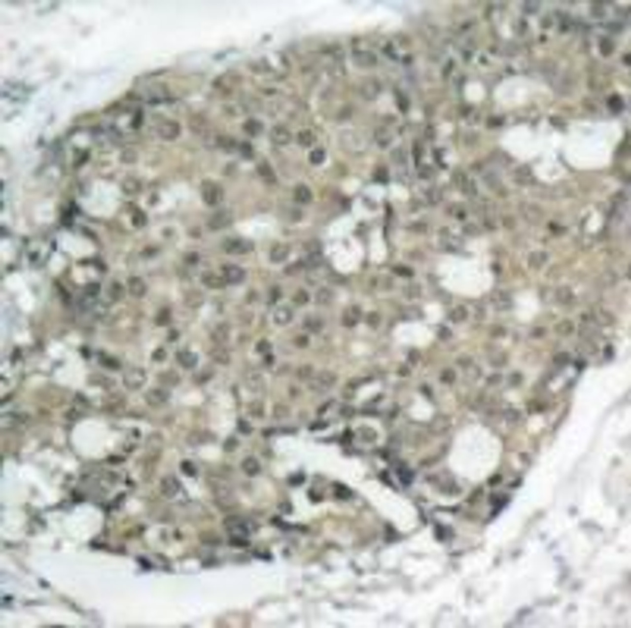 Immunohistochemical analysis of paraffin-embedded human breast carcinoma tissue using Akt (Ab-308) .
