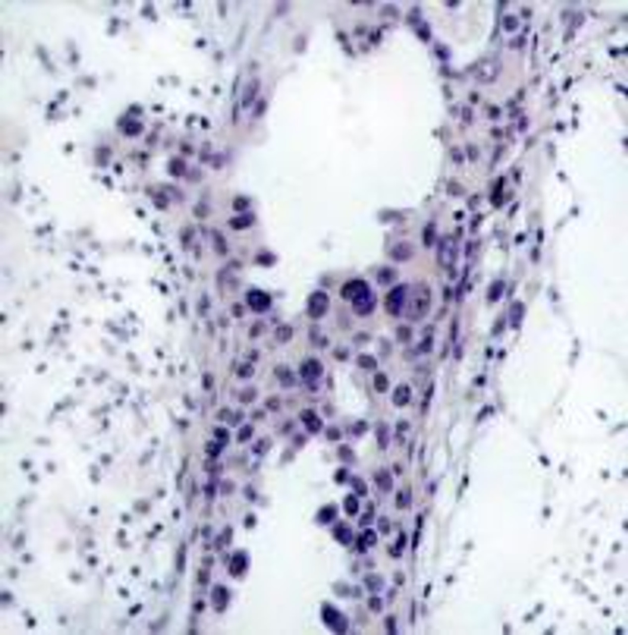 Immunohistochemical analysis of paraffin-embedded human breast carcinoma tissue using PTEN (Ab-380/382/383) .