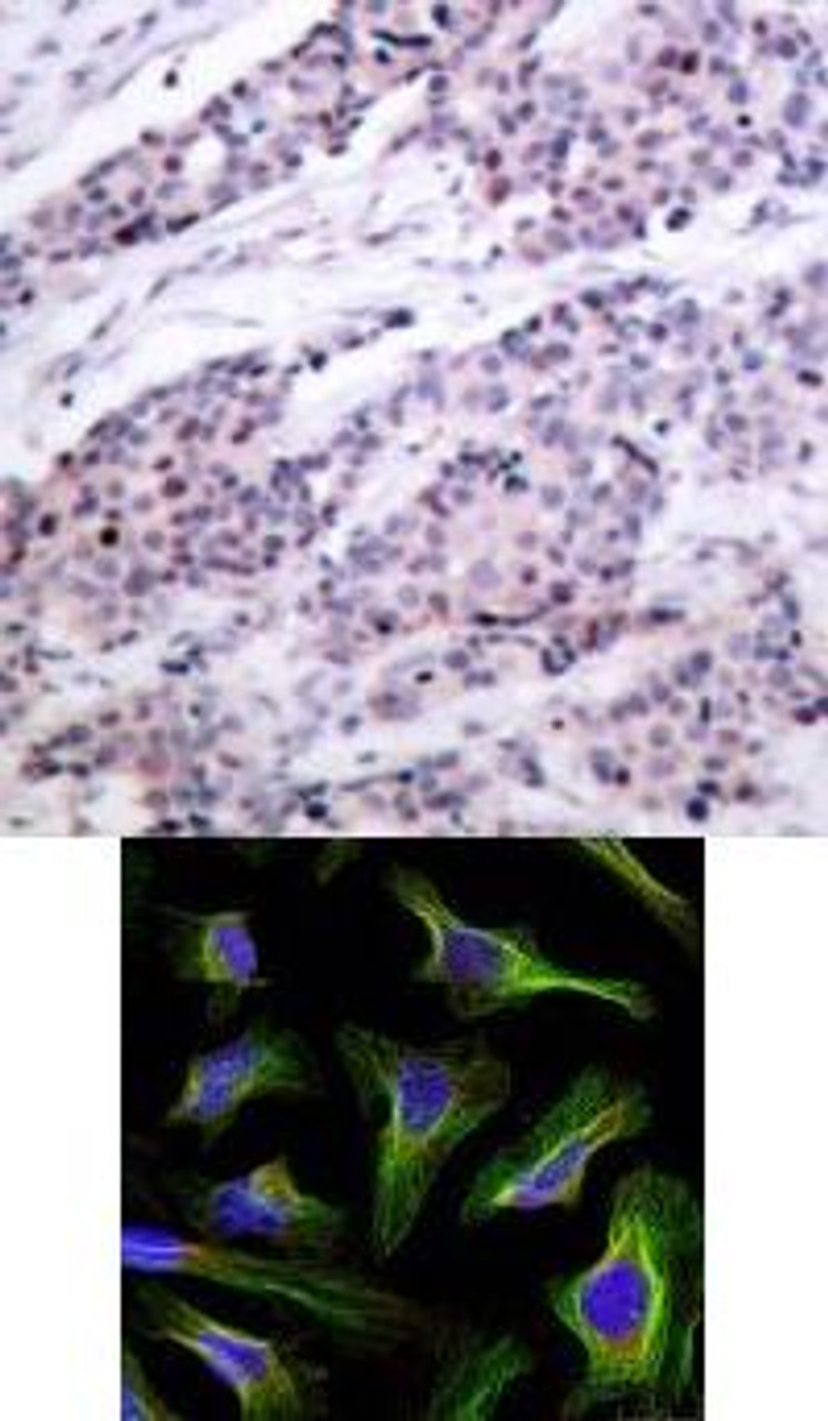 <b>Top Image:</b> Immunohistochemical analysis of paraffin-embedded human breast carcinoma tissue using BCL-2 (Ab-56) .<b>Bottom Image:</b> Immunofluorescence staining of methanol-fixed HeLa cells using BCL-2 (Ab-56) .