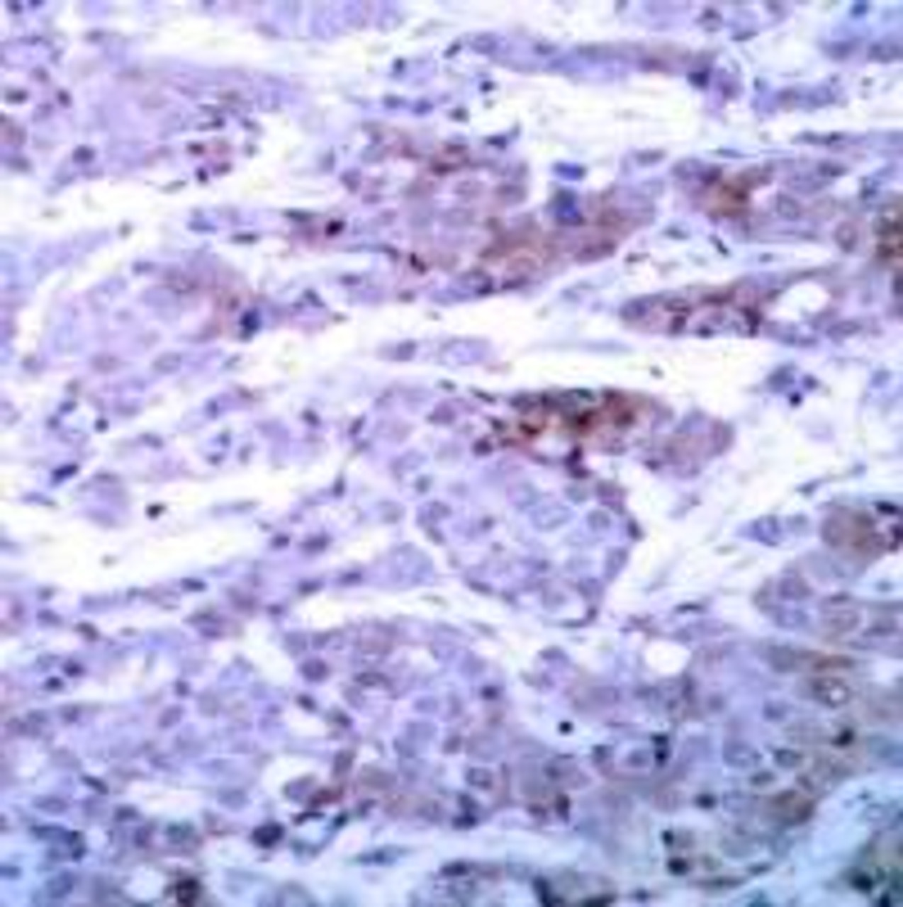 Immunohistochemical analysis of paraffin-embedded human breast carcinoma tissue using BAD (Ab-112) .