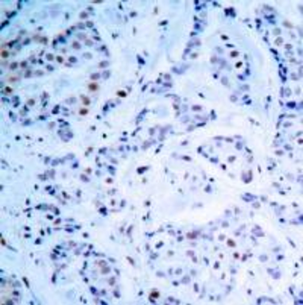 Immunohistochemical analysis of paraffin-embedded human breast carcinoma tissue using Estrogen Receptor-&#945; (Ab-104) .