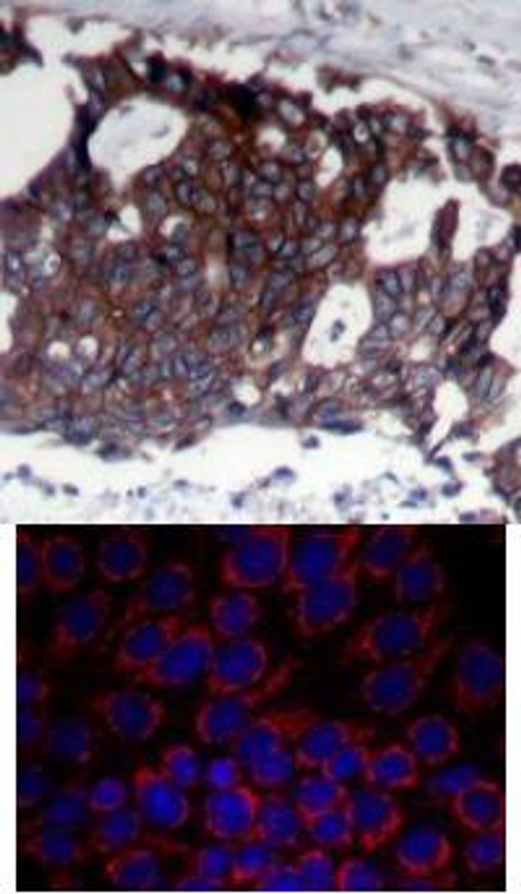 <b>Top Image:</b> Immunohistochemical analysis of paraffin-embedded human breast carcinoma tissue using HER2 (Ab-1248) .<b>Bottom Image:</b> Immunofluorescence staining of methanol-fixed MCF7 cells using HER2 (Ab-1248) .