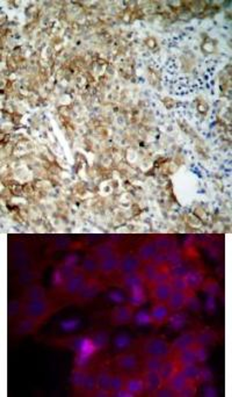 <b>Top Image:</b> Immunohistochemical analysis of paraffin-embedded human breast carcinoma tissue using IGF-1R (Ab-1161) .<b>Bottom Image:</b> Immunofluorescence staining of methanol-fixed MCF cells using IGF-1R (Ab-1161) .