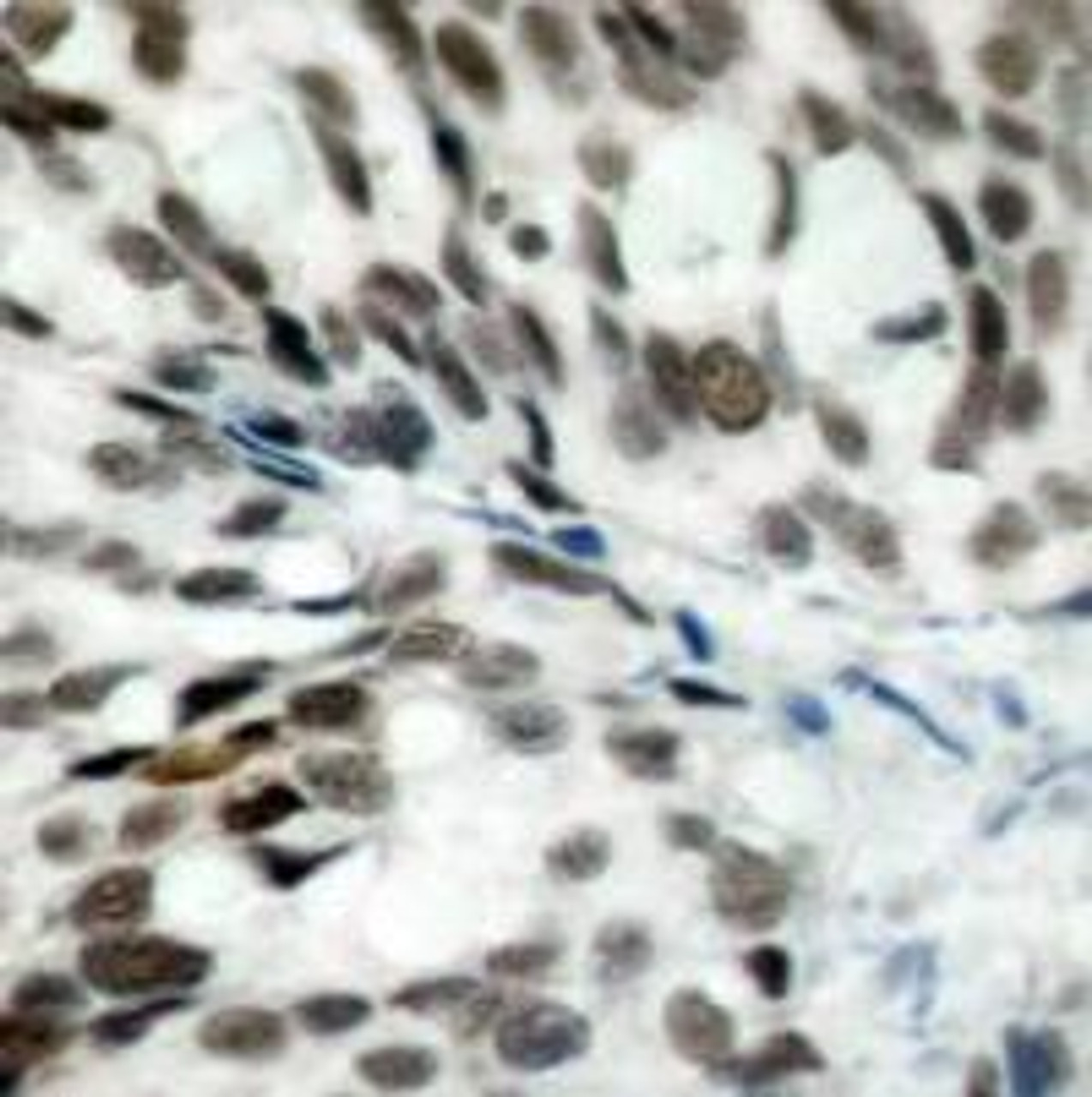 Immunohistochemical analysis of paraffin-embedded human breast carcinoma tissue using Rb (Ab-780) .