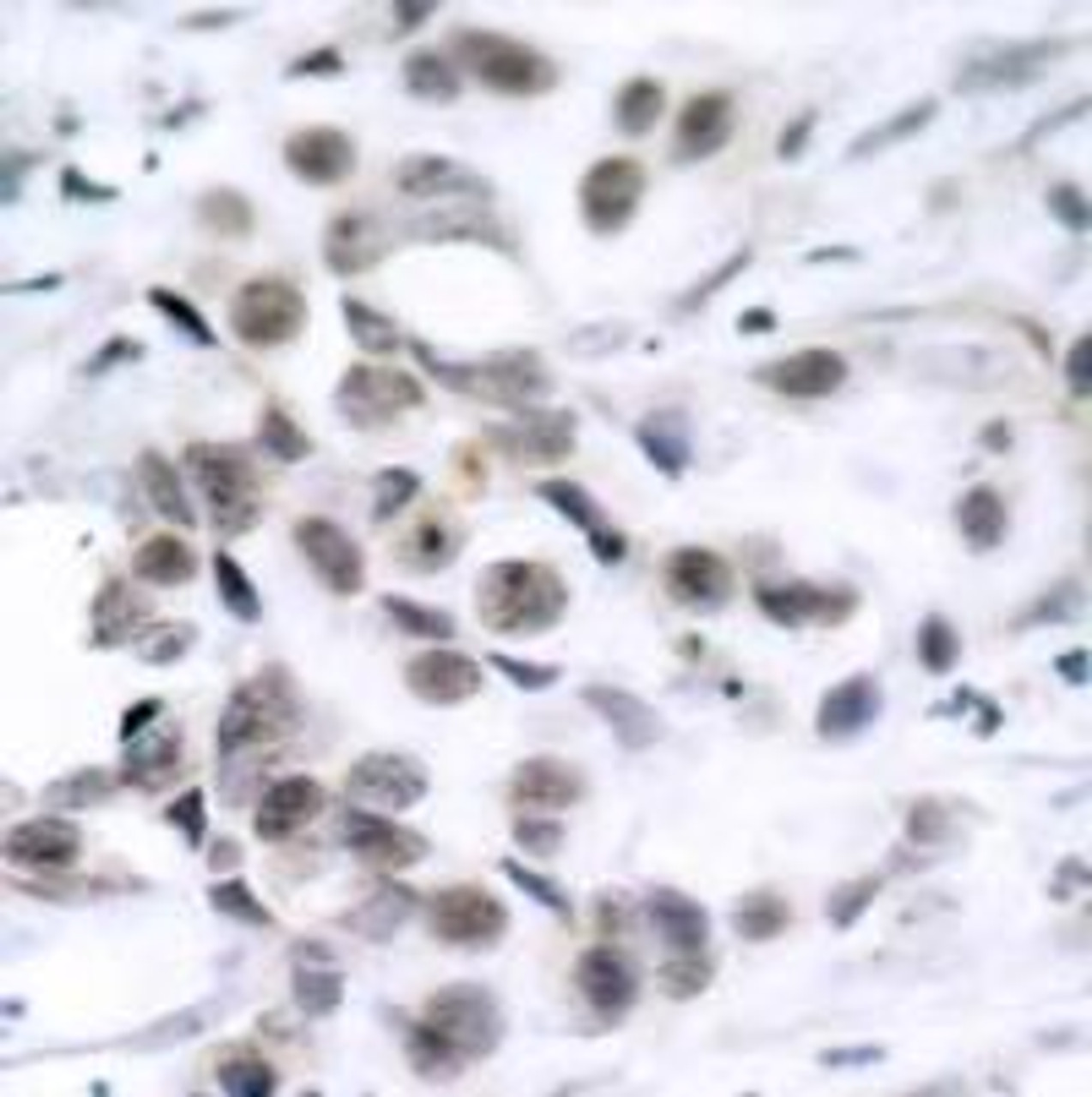 Immunohistochemical analysis of paraffin-embedded human breast carcinoma tissue using Chk1 (Ab-317) .