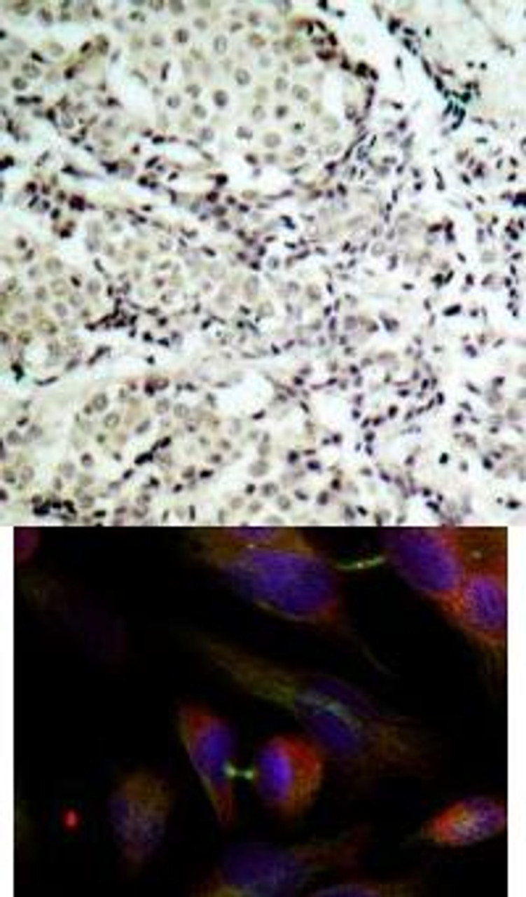 <b>Top Image:</b> Immunohistochemical analysis of paraffin-embedded human breast carcinoma tissue using MKK3 (Ab-189) .<b>Bottom Image:</b> Immunofluorescence staining of methanol-fixed HeLa cells using MKK3 (Ab-189) .
