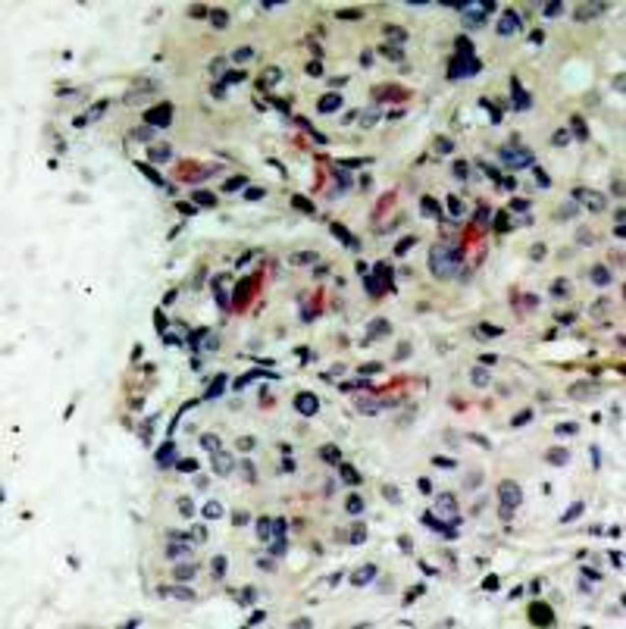 Immunohistochemical analysis of paraffin-embedded human breast carcinoma tissue using JAK1 (Ab-1022) .