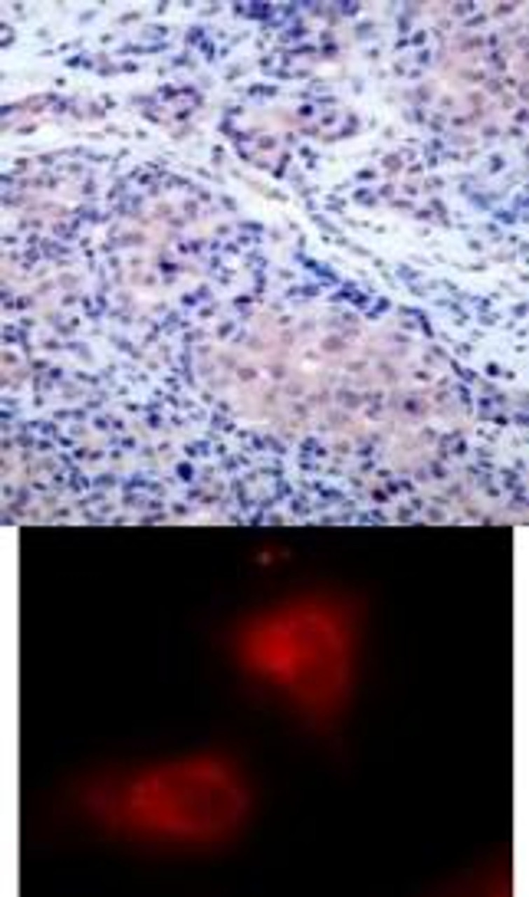 <b>Top Image:</b> Immunohistochemical analysis of paraffin-embedded human breast carcinoma tissue using IkappaB-&#945; (Ab-32/36) .<b>Bottom Image:</b> Immunofluorescence staining of methanol-fixed HeLa cells using IkappaB-&#945; (Ab-32/36) .