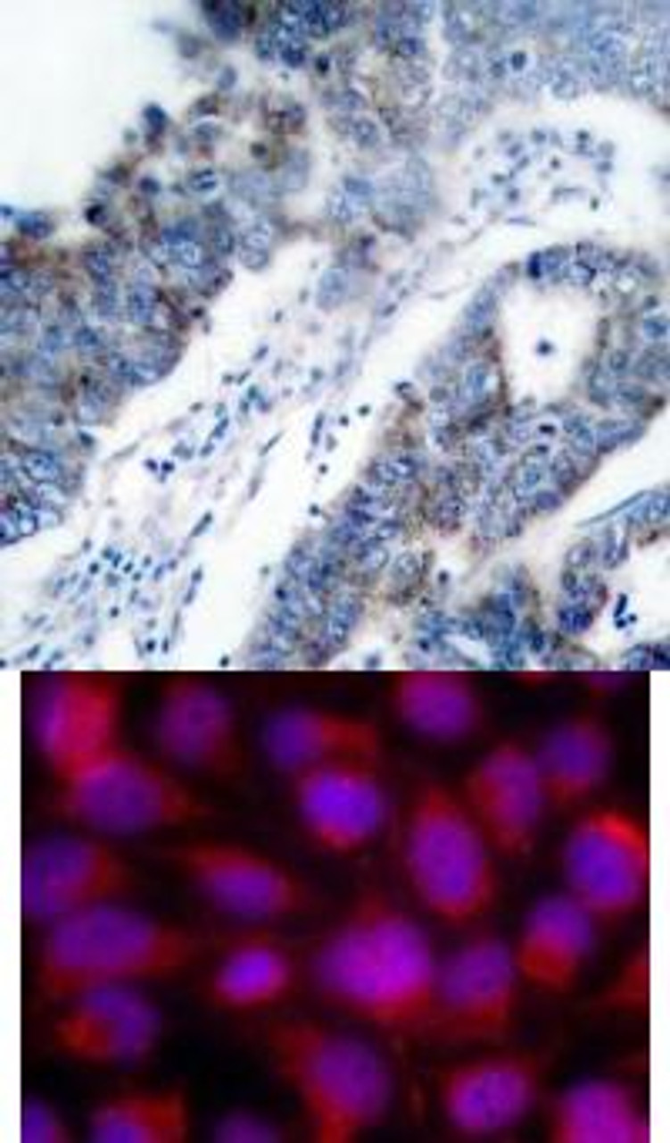 <b>Top Image:</b> Immunohistochemical analysis of paraffin-embedded human breast carcinoma tissue using ASK1 (Ab-83) .<b>Bottom Image:</b> Immunofluorescence staining of methanol-fixed HeLa cells using ASK1 (Ab-83) .