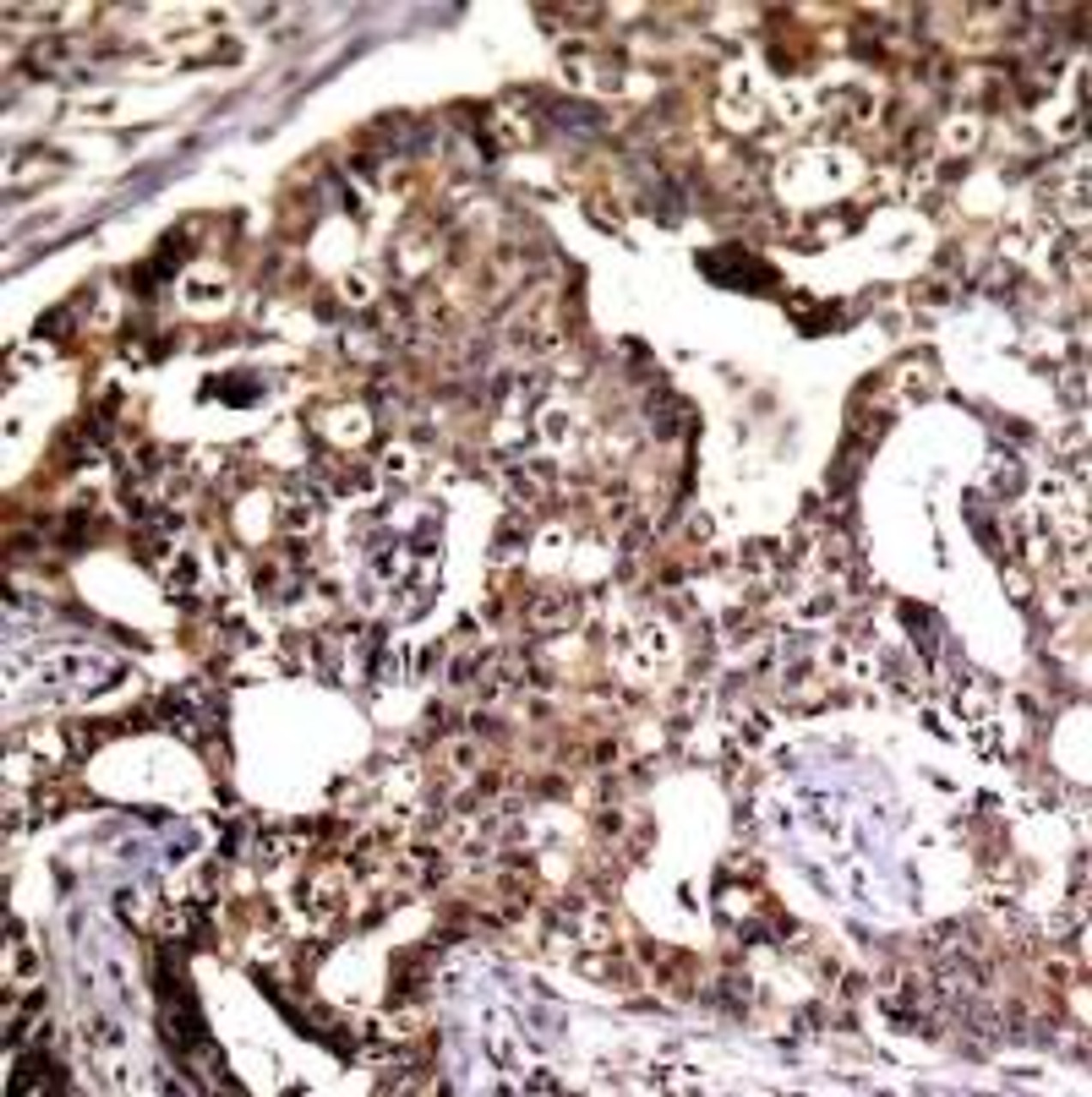 Immunohistochemical analysis of paraffin-embedded human breast carcinoma tissue using SEK1/MKK4 (Ab-80) .