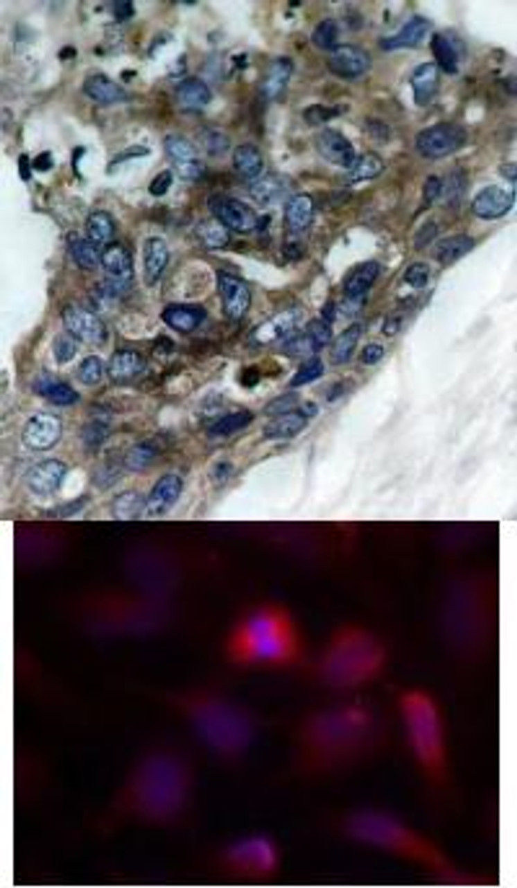 <b>Top Image:</b> Immunohistochemical analysis of paraffin-embedded human breast carcinoma tissue using ASK1 (Ab-966) .<b>Bottom Image:</b> Immunofluorescence staining of methanol-fixed HeLa cells using ASK1 (Ab-966) .