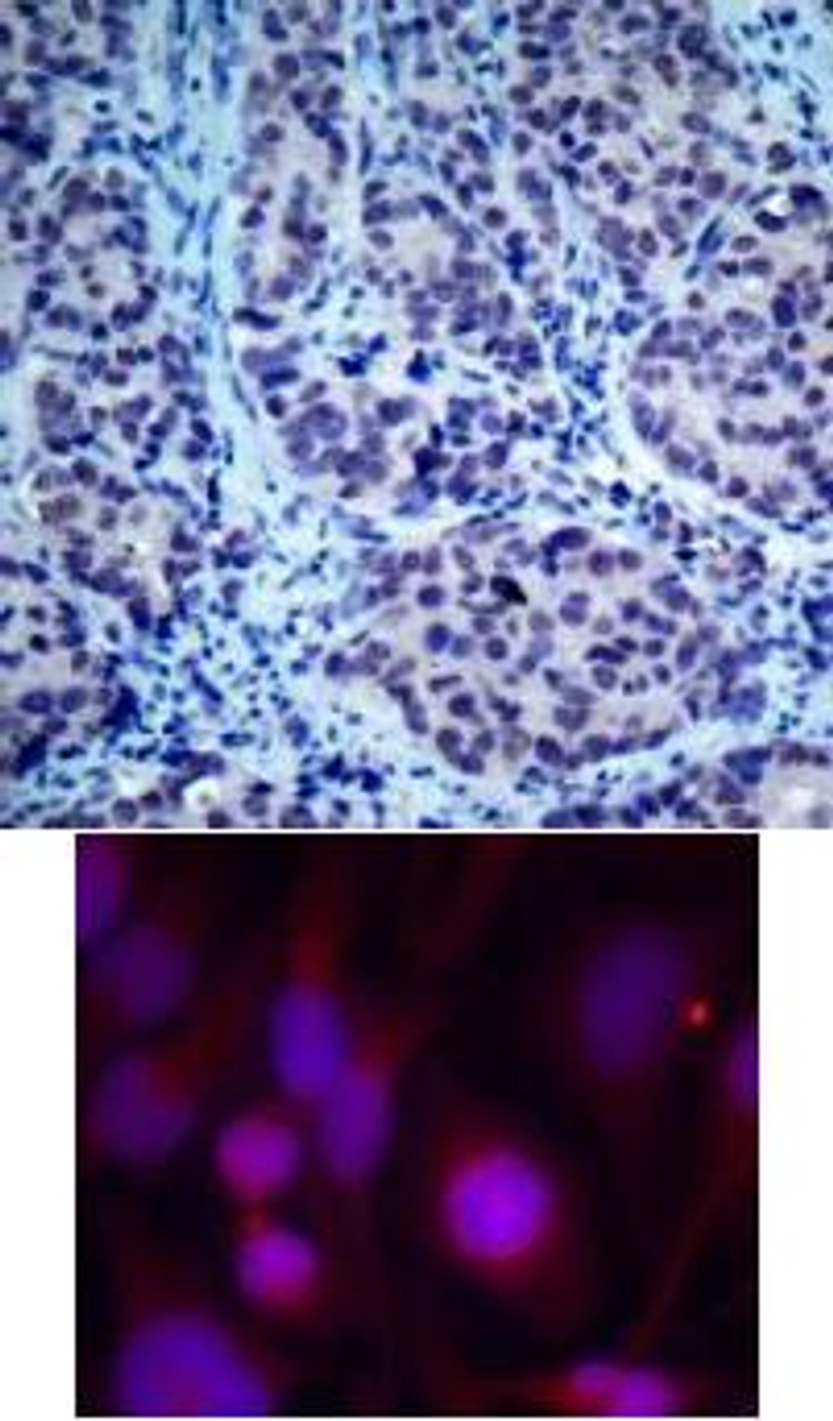 <b>Top Image:</b> Immunohistochemical analysis of paraffin-embedded human breast carcinoma tissue using HDAC2 (Ab-394) .<b>Bottom Image:</b> Immunofluorescence staining of methanol-fixed HeLa cells using HDAC2 (Ab-394) .