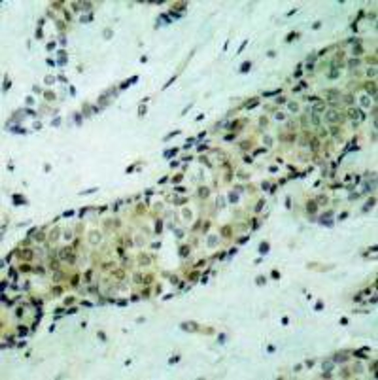 Immunohistochemical analysis of paraffin-embedded human breast carcinoma tissue using HDAC5 (Ab-498) .