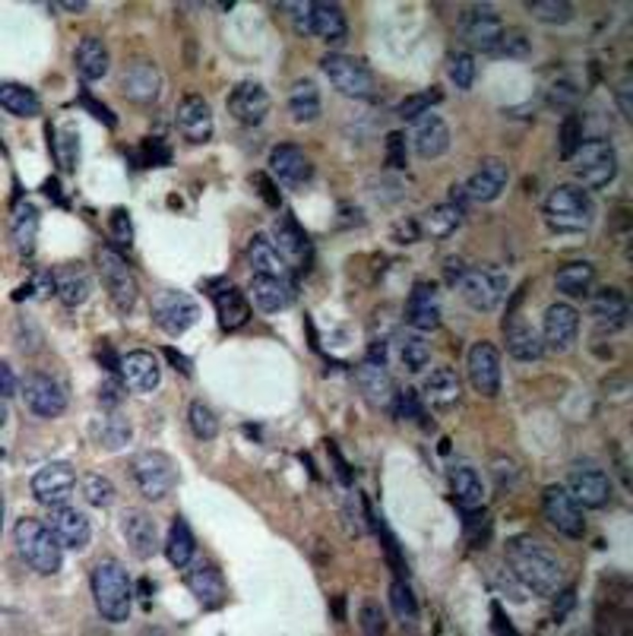 Immunohistochemical analysis of paraffin-embedded human breast carcinoma tissue using HSP27 (Ab-15) .