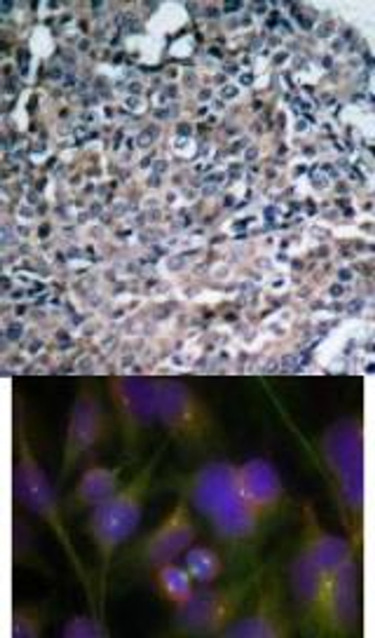 <b>Top Image:</b> Immunohistochemical analysis of paraffin-embedded human breast carcinoma tissue using FAK (Ab-925) .<b>Bottom Image:</b> Immunofluorescence staining of methanol-fixed HeLa cells using FAK (Ab-925) .