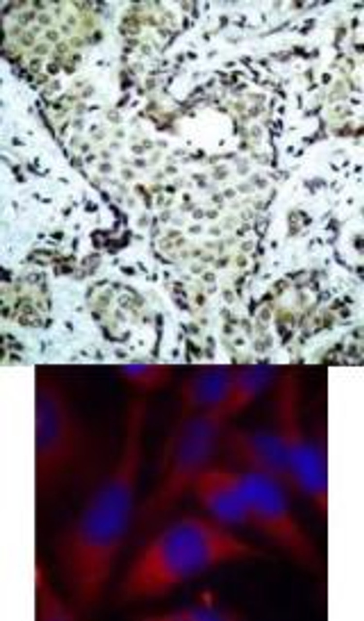 <b>Top Image:</b> Immunohistochemical analysis of paraffin-embedded human breast carcinoma tissue using MKK6 (Ab-207) .<b>Bottom Image:</b> Immunofluorescence staining of methanol-fixed HeLa cells using MKK6 (Ab-207) .