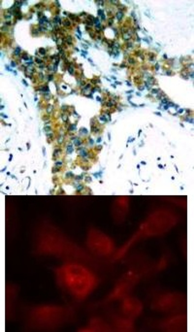 <b>Top Image:</b> Immunohistochemical analysis of paraffin-embedded human breast carcinoma tissue using PAK1/PAK2/PAK3 (Ab-423/402/421) .<b>Bottom Image:</b> Immunofluorescence staining of methanol-fixed HeLa cells using PAK1/PAK2/PAK3 (Ab-423/402/421) .