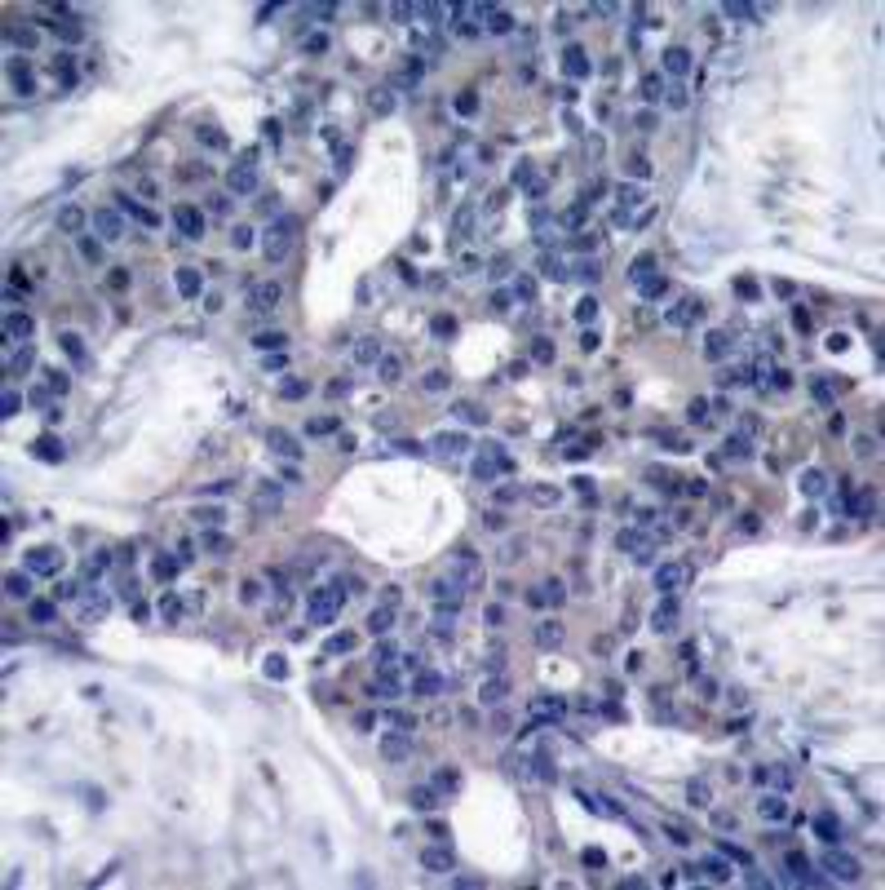 Immunohistochemical analysis of paraffin-embedded human breast carcinoma tissue using Zap-70 (Ab-493) .