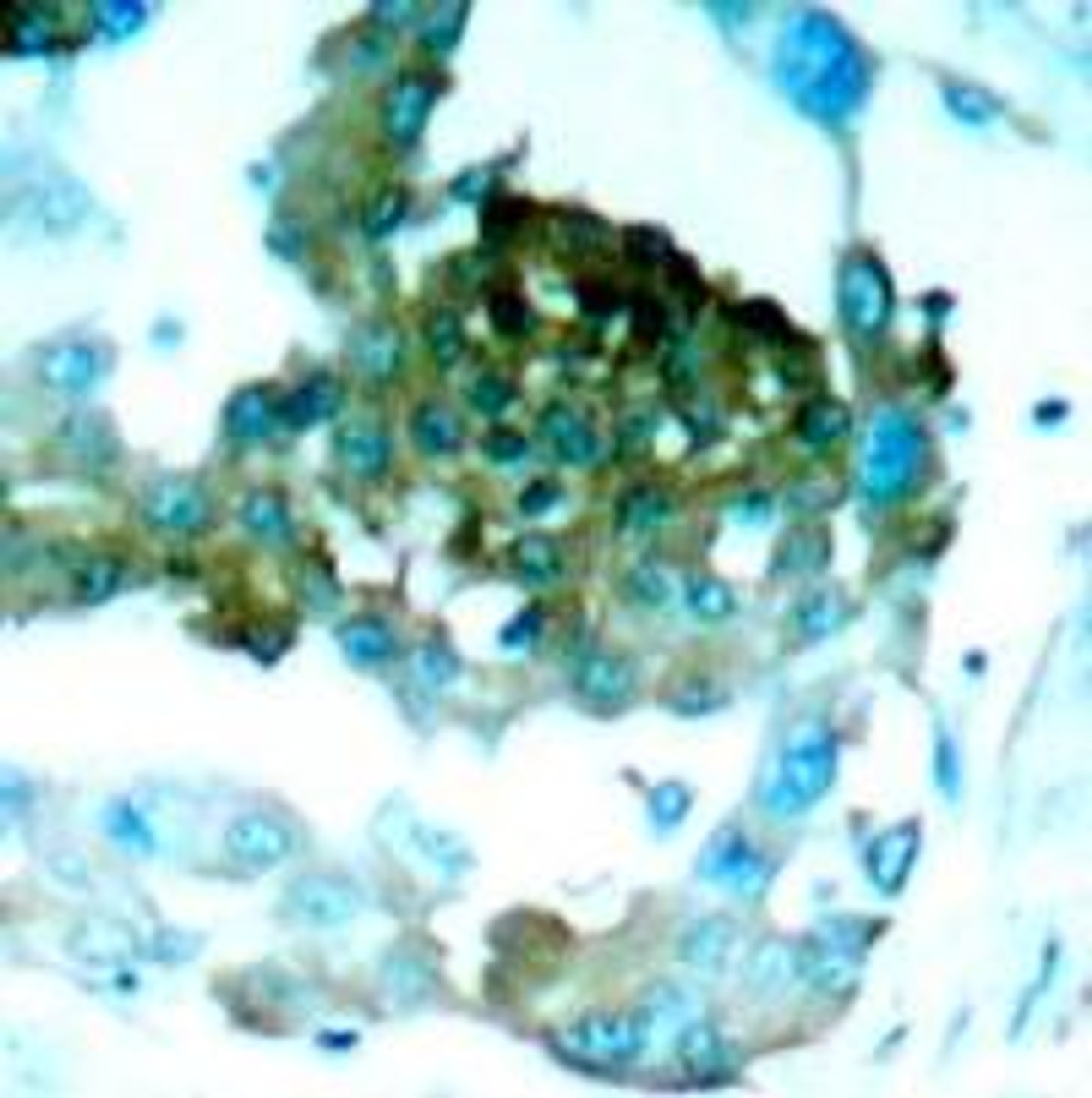 Immunohistochemical analysis of paraffin-embedded human lung carcinoma tissue using PKC&#920; (Ab-695) .