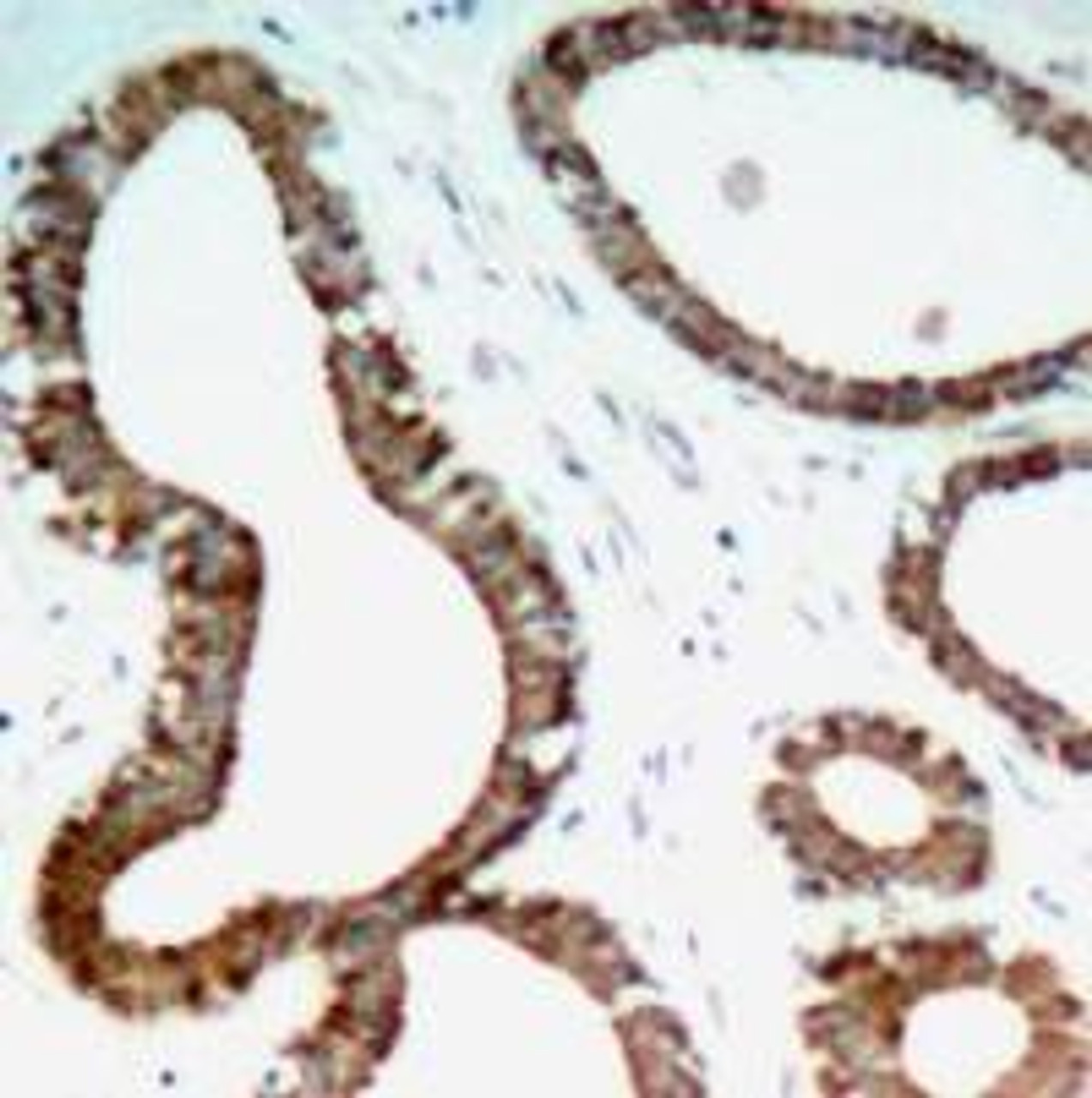 Immunohistochemical analysis of paraffin-embedded human breast carcinoma tissue using 14-3-3 zeta (Ab-58) .