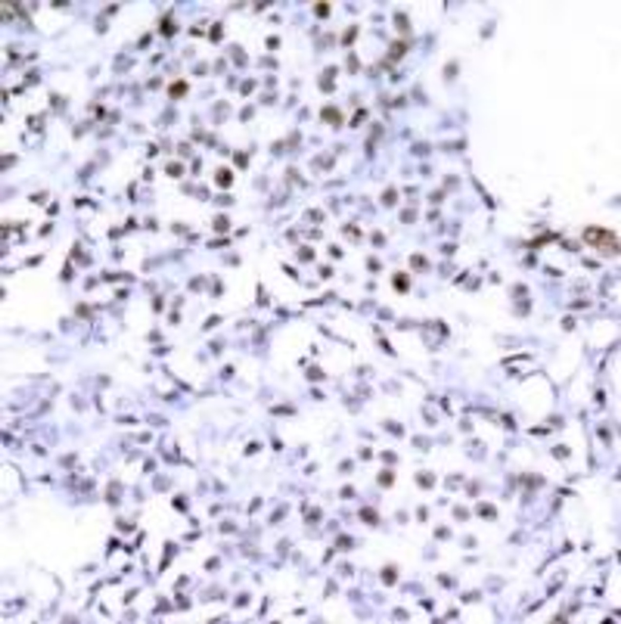 Immunohistochemical analysis of paraffin-embedded human breast carcinoma tissue using SMC1 (Ab-957) .