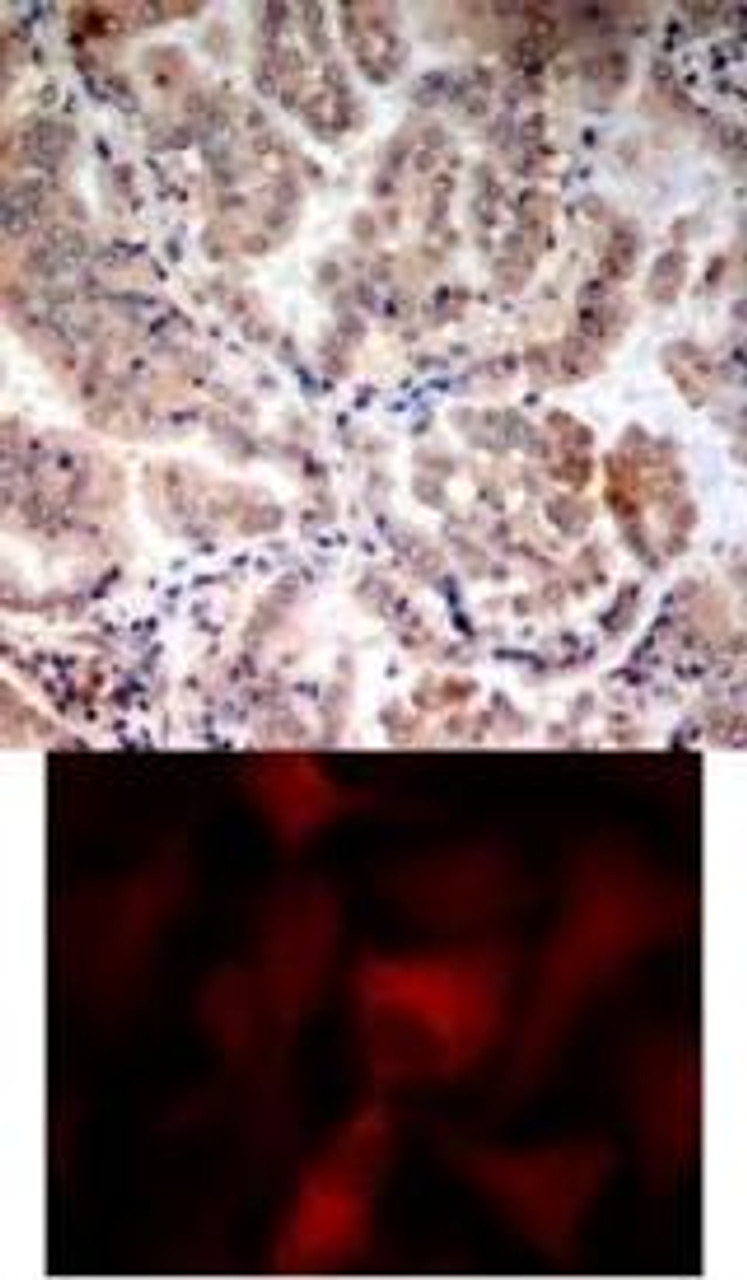 <b>Top Image:</b> Immunohistochemical analysis of paraffin-embedded human breast carcinoma tissue using AMPK&#945;1/AMPK&#945;2 (Ab-174/172) .<b>Bottom Image:</b> Immunofluorescence staining of methanol-fixed HeLa cells using AMPK&#945;1/AMPK&#945;2 (Ab-174/172) .