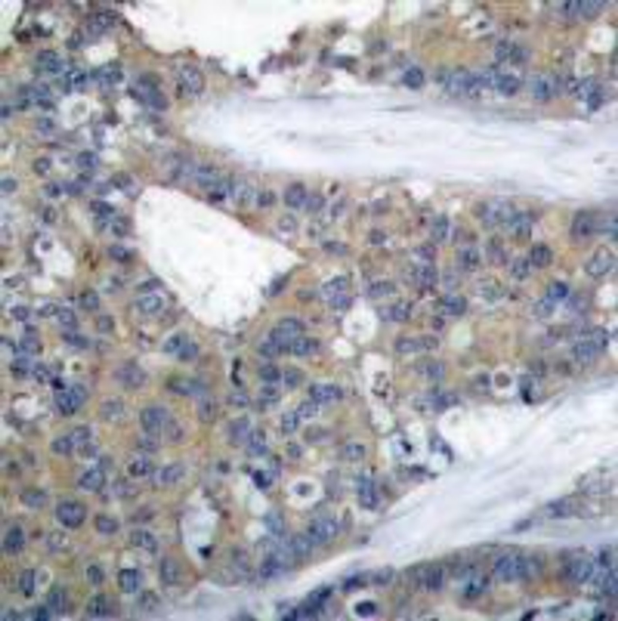 Immunohistochemical analysis of paraffin-embedded human breast carcinoma tissue using Paxillin (Ab-31) .