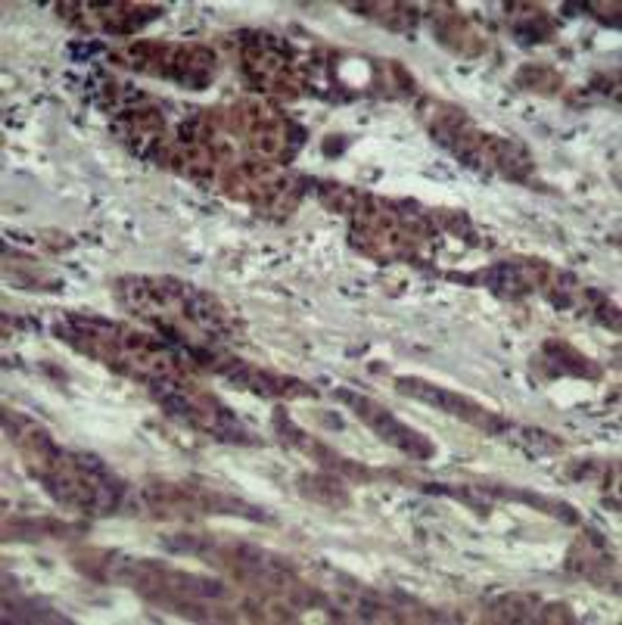 Immunohistochemical analysis of paraffin-embedded human breast carcinoma tissue using Raf1 (Ab-338) .