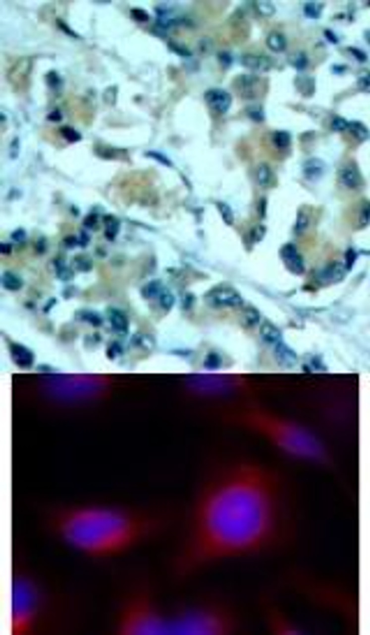 <b>Top Image:</b> Immunohistochemical analysis of paraffin-embedded human lung carcinoma tissue using MEK1/MEK2 (Ab-217/221) .<b>Bottom Image:</b> Immunofluorescence staining of methanol-fixed HeLa cells using MEK1/MEK2 (Ab-217/221) .