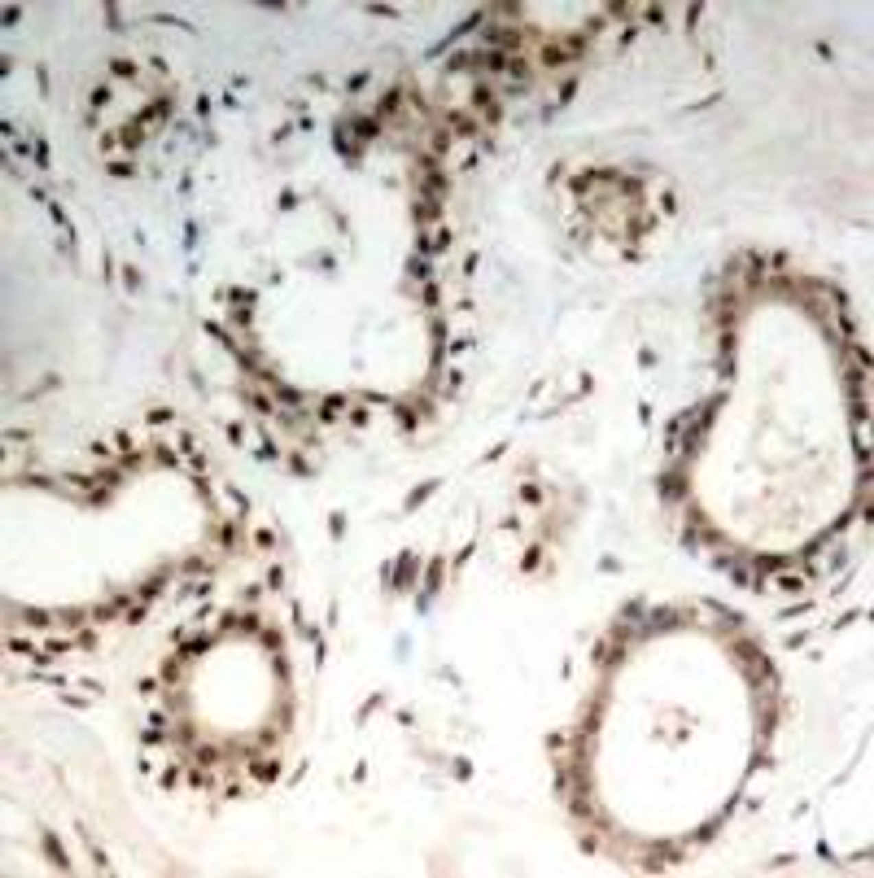 Immunohistochemical analysis of paraffin-embedded human breast carcinoma tissue using HSF1 (Ab-307) .