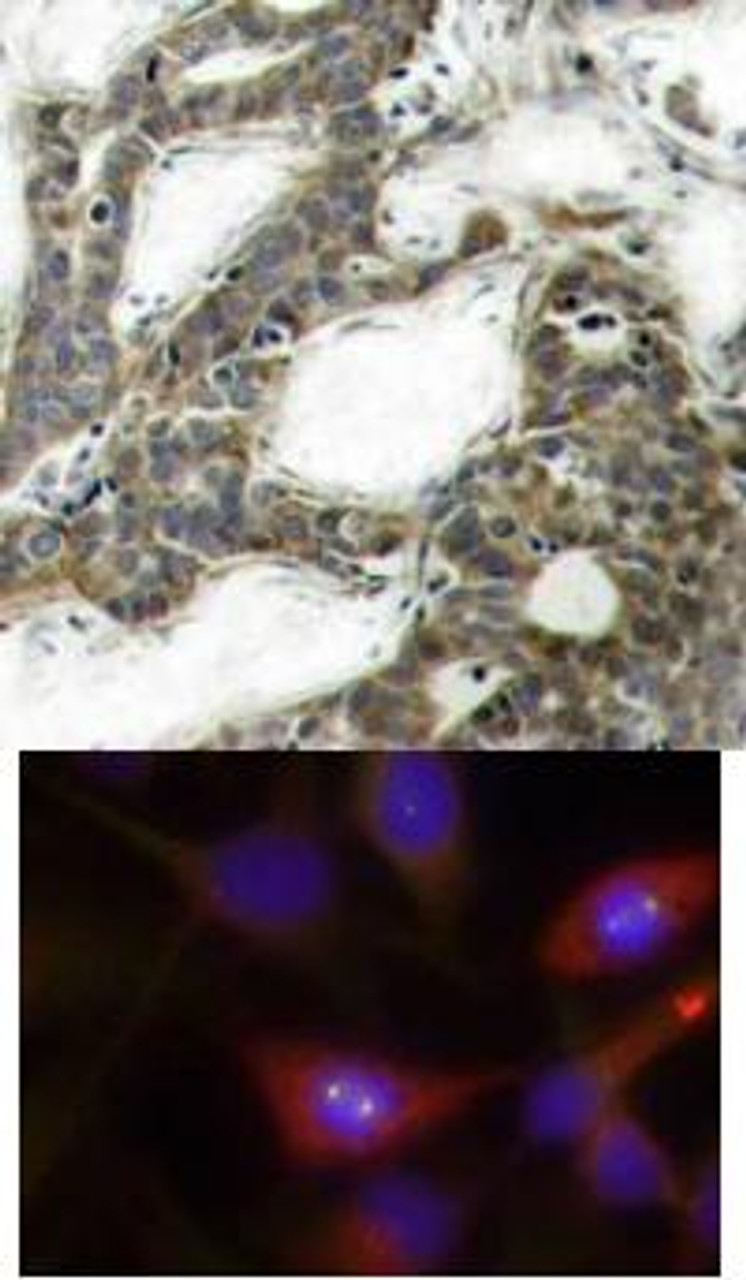 <b>Top Image:</b> Immunohistochemical analysis of paraffin-embedded human breast carcinoma tissue using &#946;-Catenin (Ab-33) .<b>Bottom Image:</b> Immunofluorescence staining of methanol-fixed HeLa cells using &#946;-Catenin (Ab-33) .