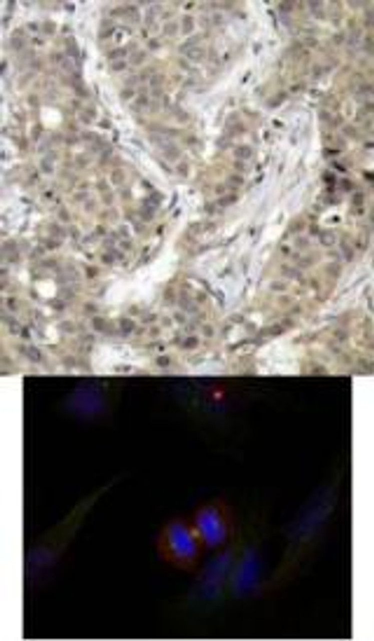 <b>Top Image:</b> Immunohistochemical analysis of paraffin-embedded human breast carcinoma tissue using &#946;-Catenin (Ab-37) .<b>Bottom Image:</b> Immunofluorescence staining of methanol-fixed HeLa cells using &#946;-Catenin (Ab-37) .