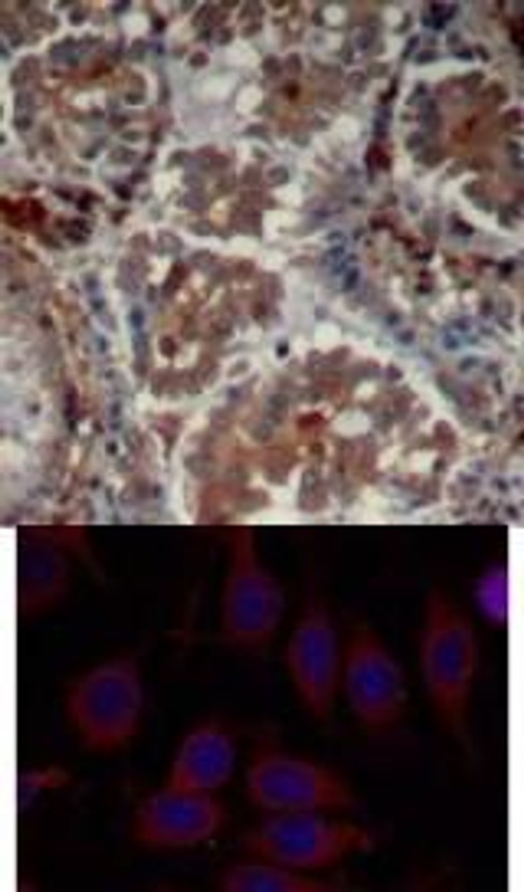 <b>Top Image:</b> Immunohistochemical analysis of paraffin-embedded human Lung carcinoma tissue using mTOR (Ab-2448) .<b>Bottom Image:</b> Immunofluorescence staining of methanol-fixed MCF7 cells using mTOR (Ab-2448) .
