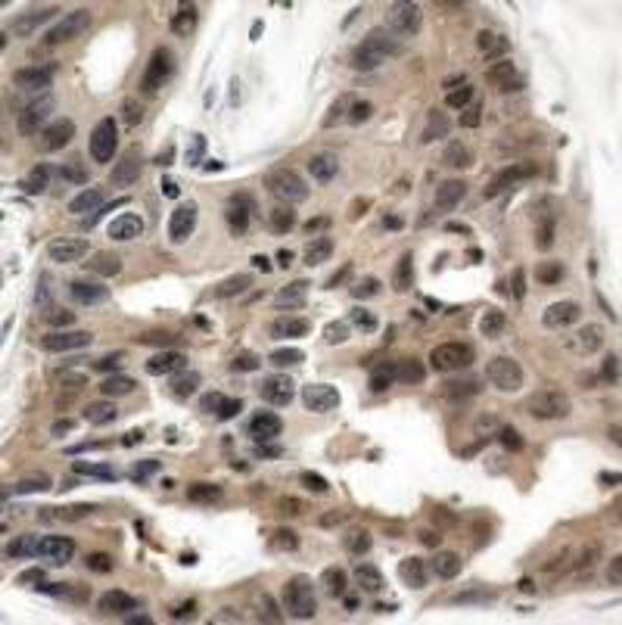 Immunohistochemical analysis of paraffin-embedded human breast carcinoma tissue using 4E-BP1 (Ab-36) .