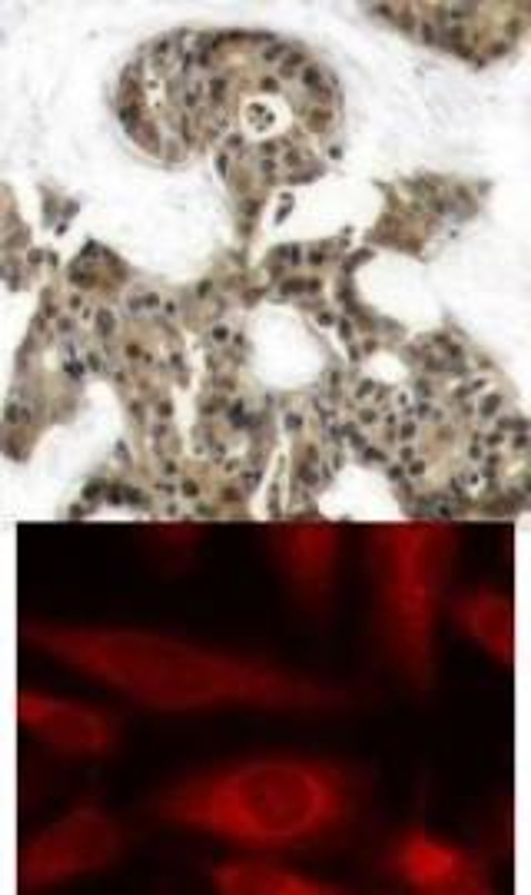 <b>Top Image:</b> Immunohistochemical analysis of paraffin-embedded human breast carcinoma tissue using 4E-BP1 (Ab-45) .<b>Bottom Image:</b> Immunofluorescence staining of methanol-fixed HeLa cells using 4E-BP1 (Ab-45) .