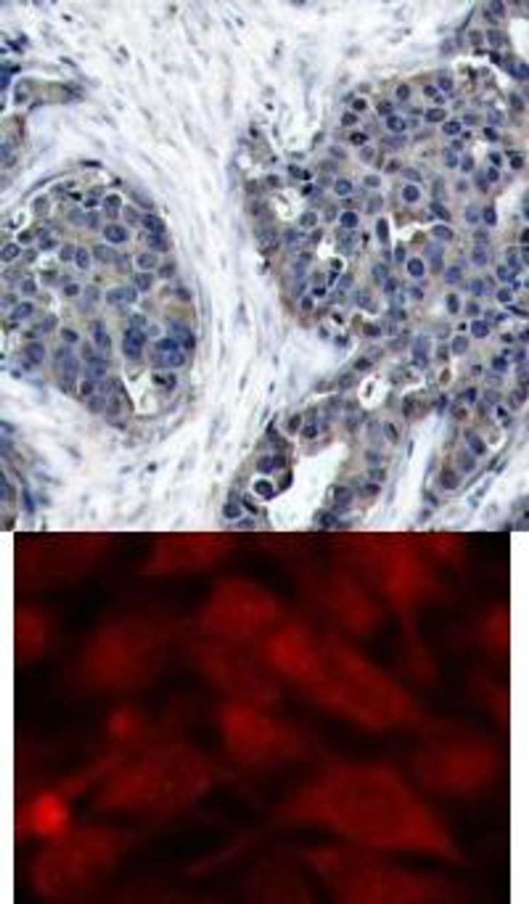 <b>Top Image:</b> Immunohistochemical analysis of paraffin-embedded human breast carcinoma tissue using Stathmin 1 (Ab-38) .<b>Bottom Image:</b> Immunofluorescence staining of methanol-fixed HeLa cells using Stathmin 1 (Ab-38) .