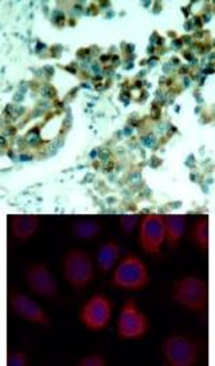 <b>Top Image:</b> Immunohistochemical analysis of paraffin- embedded human lung carcinoma tissue using S6 Ribosomal Protein (Ab-235) .<b>Bottom Image:</b> Immunofluorescence staining of methanol-fixed MCF7 cells using S6 Ribosomal Protein (Ab-235) .