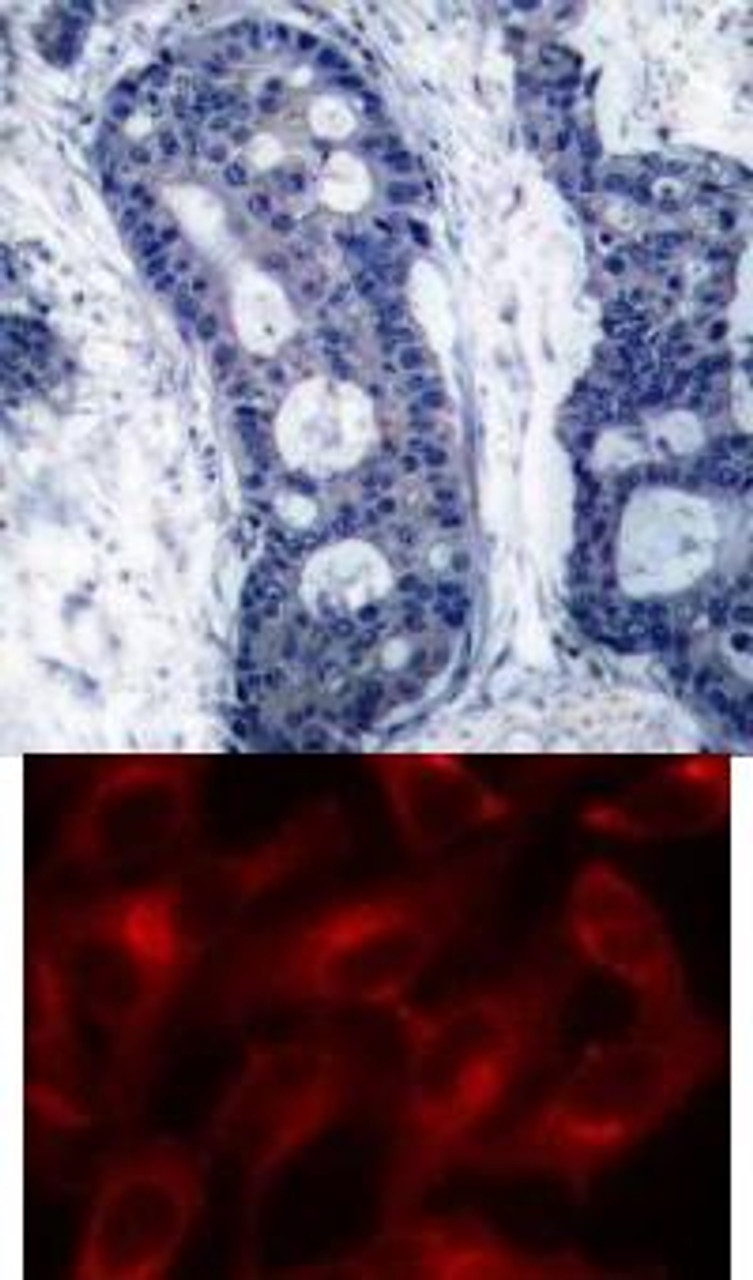 <b>Top Image:</b> Immunohistochemical analysis of paraffin-embedded human breast carcinoma tissue using eIF4E (Ab-209) .<b>Bottom Image:</b> Immunofluorescence staining of methanol-fixed HeLa cells using eIF4E (Ab-209) .