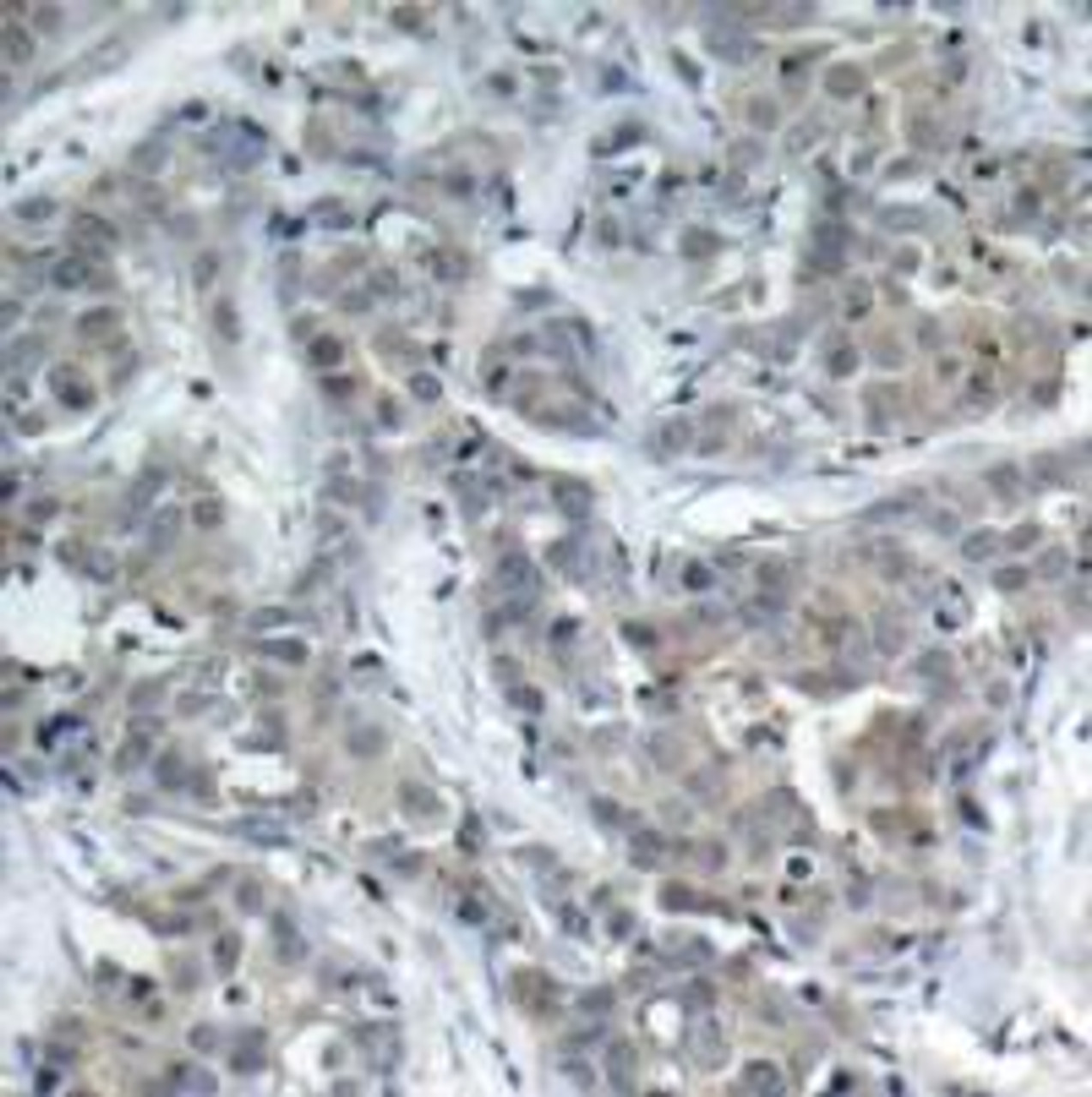 Immunohistochemical analysis of paraffin-embedded human breast carcinoma tissue using Stathmin 1 (Ab-16) .