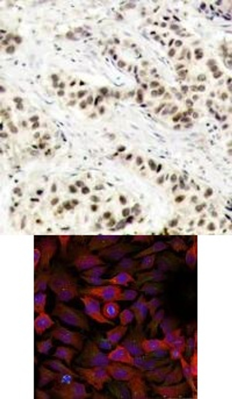 <b>Top Image:</b> Immunohistochemical analysis of paraffin-embedded human breast carcinoma tissue using CDC2 (Ab-15) .<b>Bottom Image:</b> Immunofluorescence staining of methanol-fixed HeLa cells using CDC2 (Ab-15) .