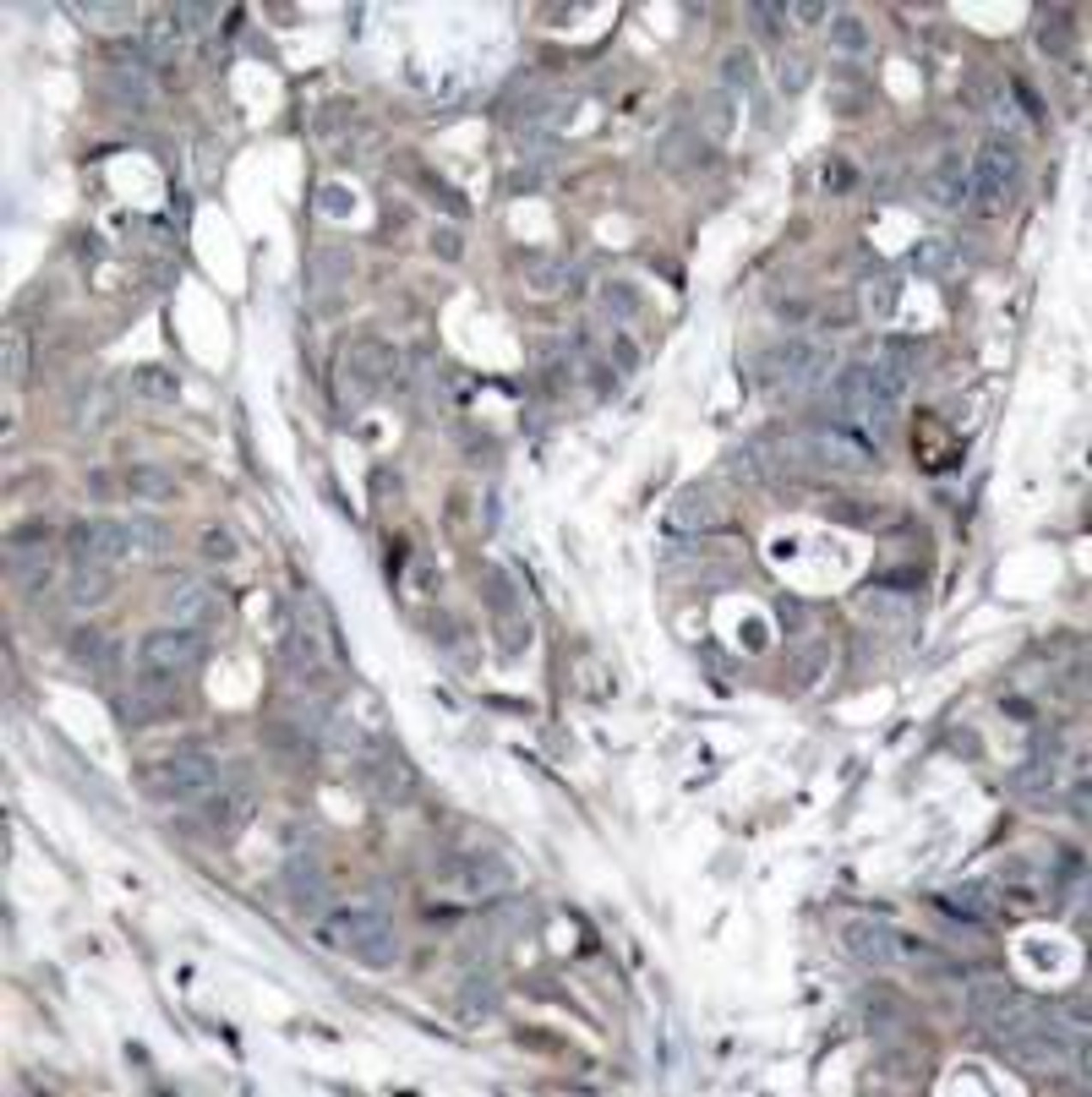 Immunohistochemical analysis of paraffin-embedded human breast carcinoma tissue using HSP27 (Ab-78) .