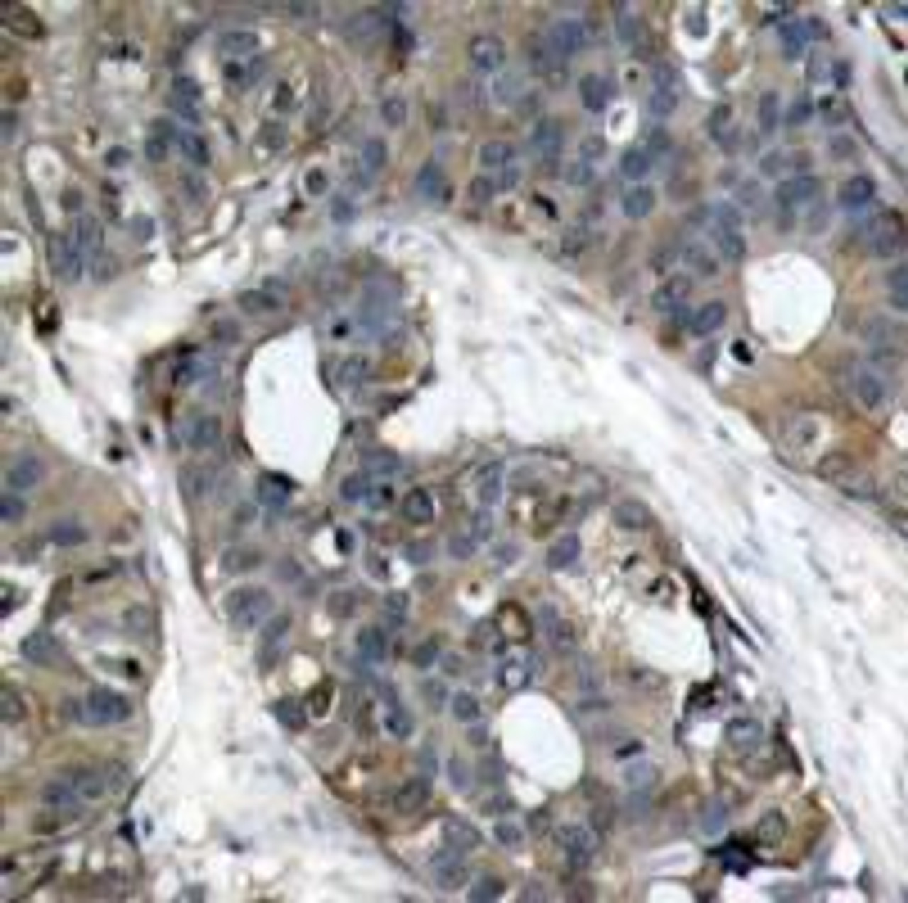 Immunohistochemical analysis of paraffin-embedded human breast carcinoma tissue using HSP27 (Ab-82) .