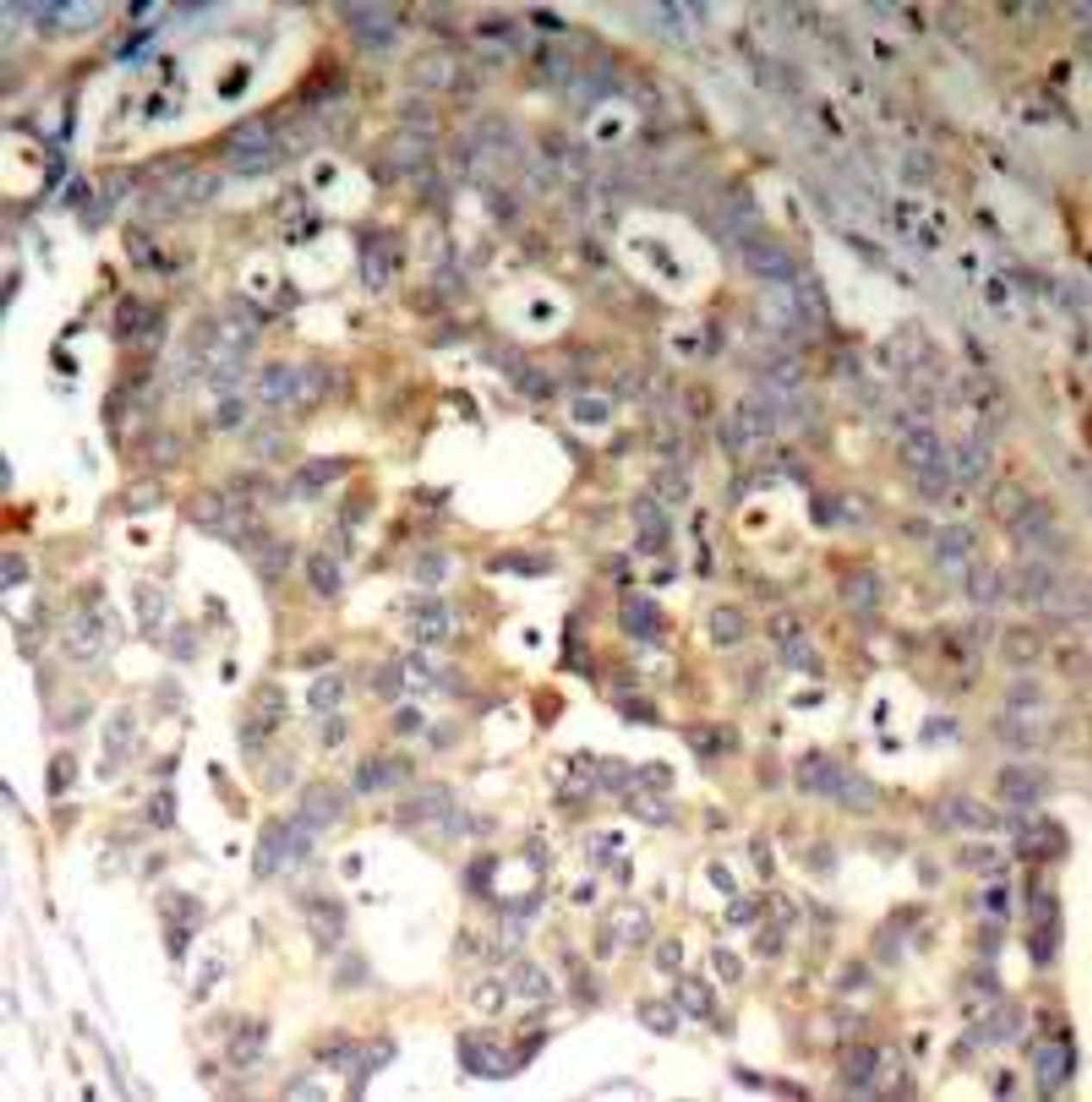 Immunohistochemical analysis of paraffin-embedded human breast carcinoma tissue using SAPK/JNK (Ab-183) .